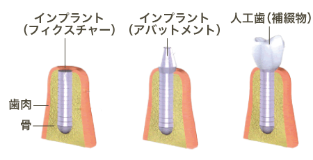 インプラントの構造と名称