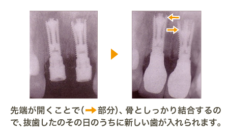 サルゴンインプラント